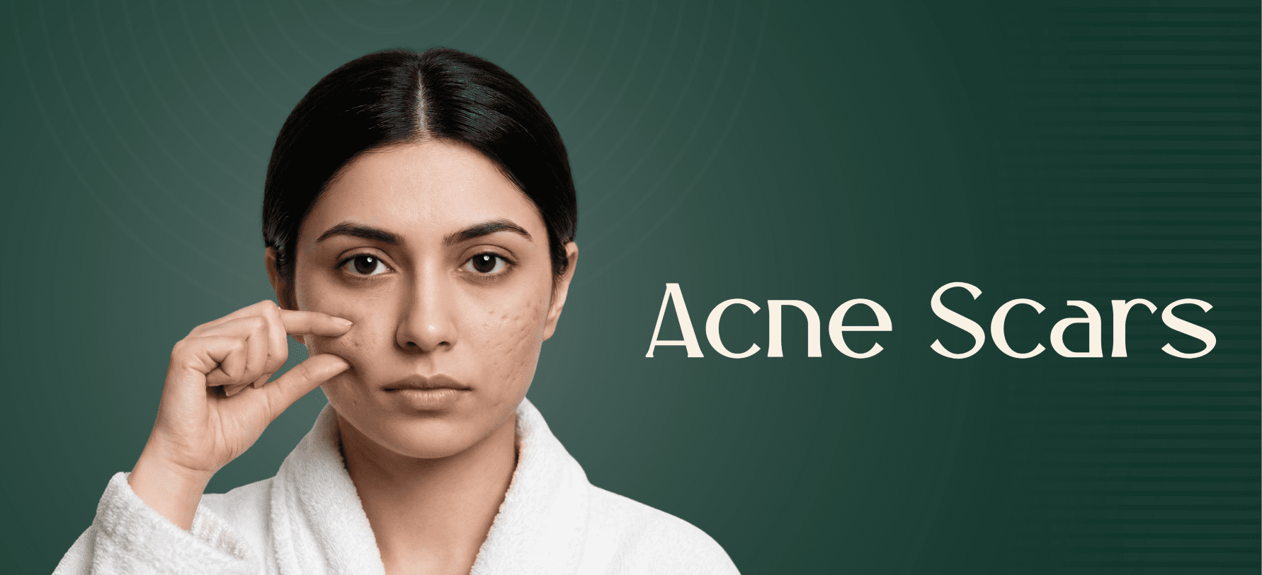 Acne and Acne Scars Treatment