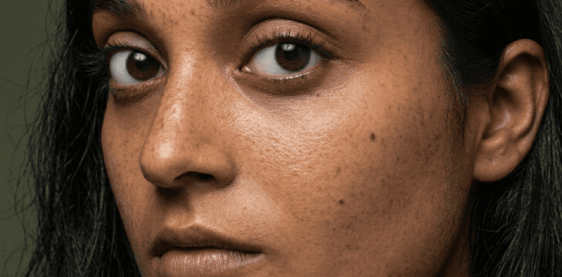 Dull Skin Treatment Clinic