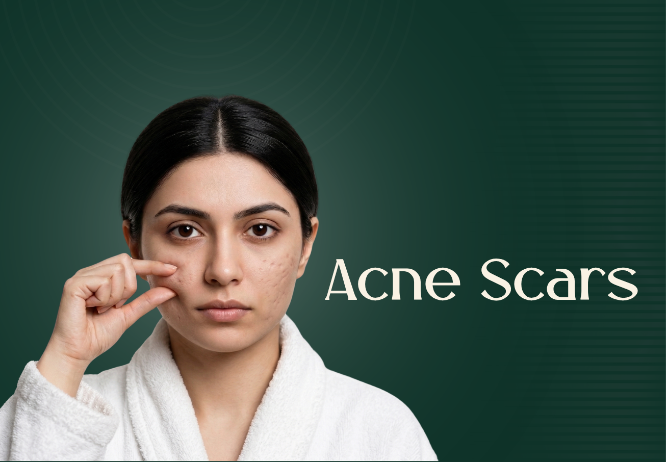 Acne and Acne scar Treatment in Mohali