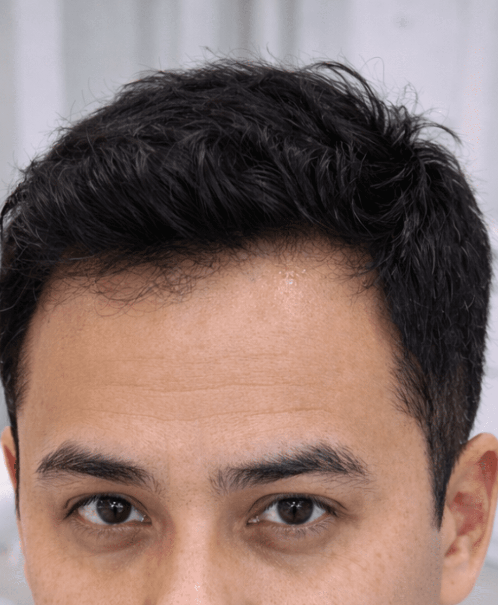 Hair Loss Treatment After Results