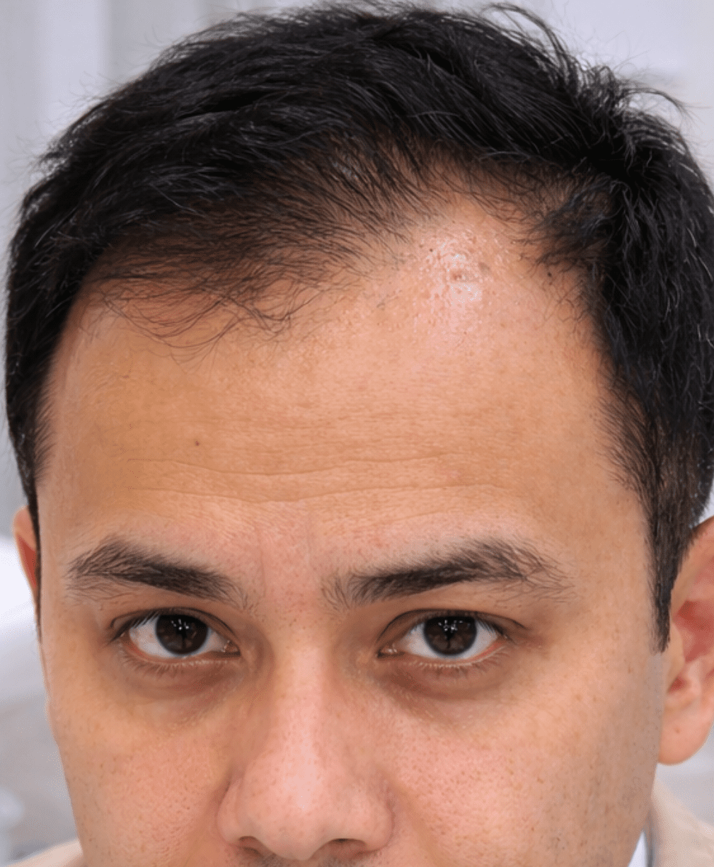 Before Hair Restoration Treatment