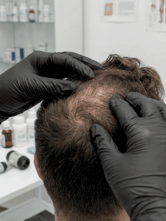 Hair Loss Treatment in Mohali